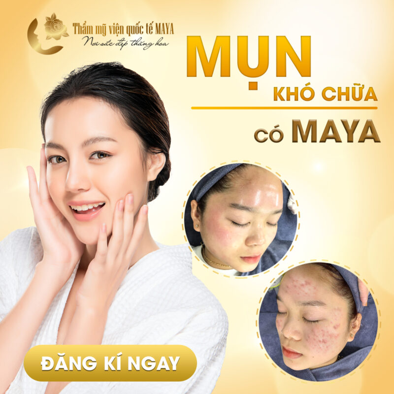 TRỊ MỤN CÔNG NGHỆ CAO 