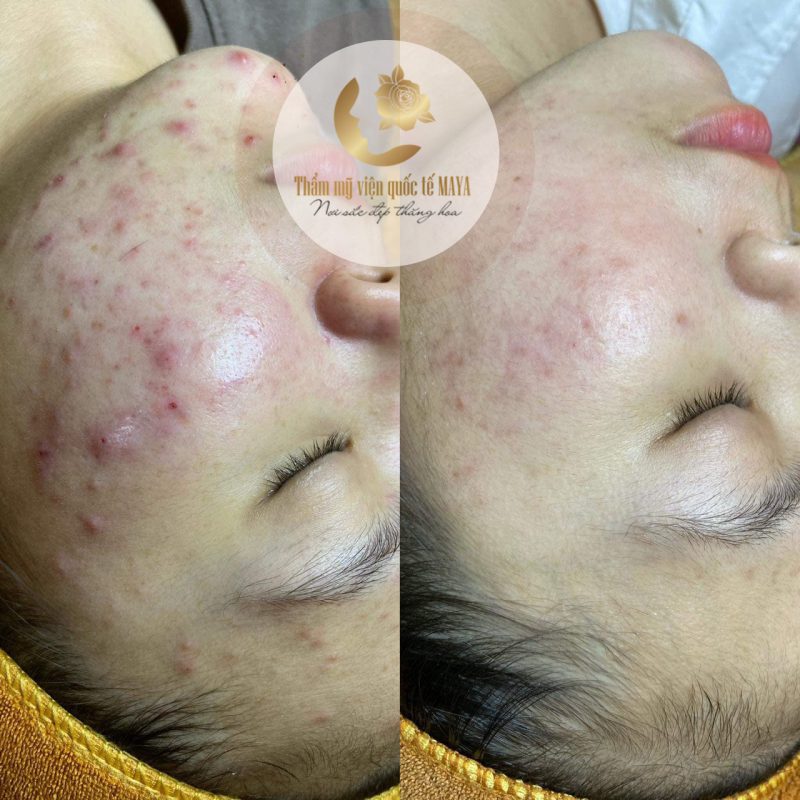Hình ảnh khách hàng trước và sau trị mụn