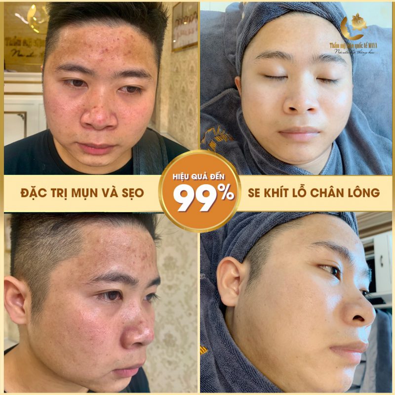 Hình ảnh khách hàng trước và sau trị mụn