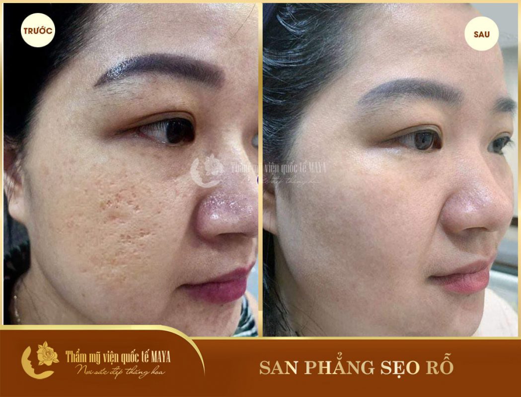 Hình ảnh khách hàng trước và sau trị mụn