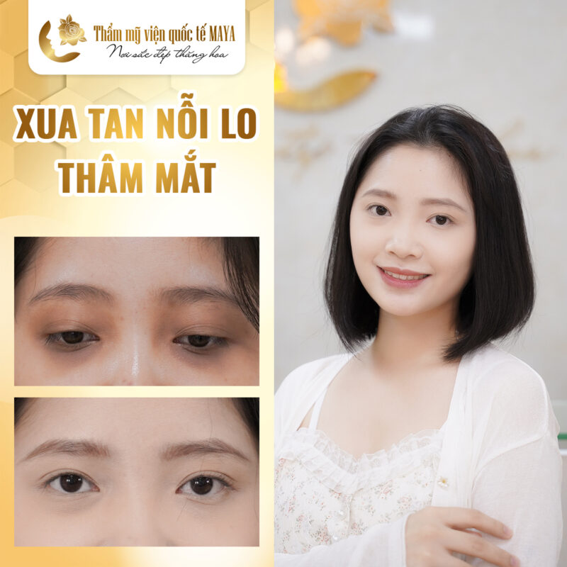 ĐIỀU TRỊ THÂM MẮT 