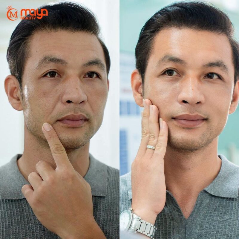 XOÁ NHĂN RÃNH CƯỜI FACIAL MATRIX 