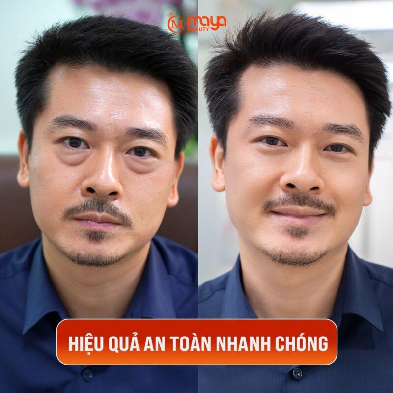 XOÁ BỌNG MỠ MẮT DERMA WAVE 