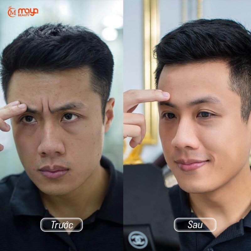XOÁ NHĂN ẤN ĐƯỜNG CEN FACIAL 